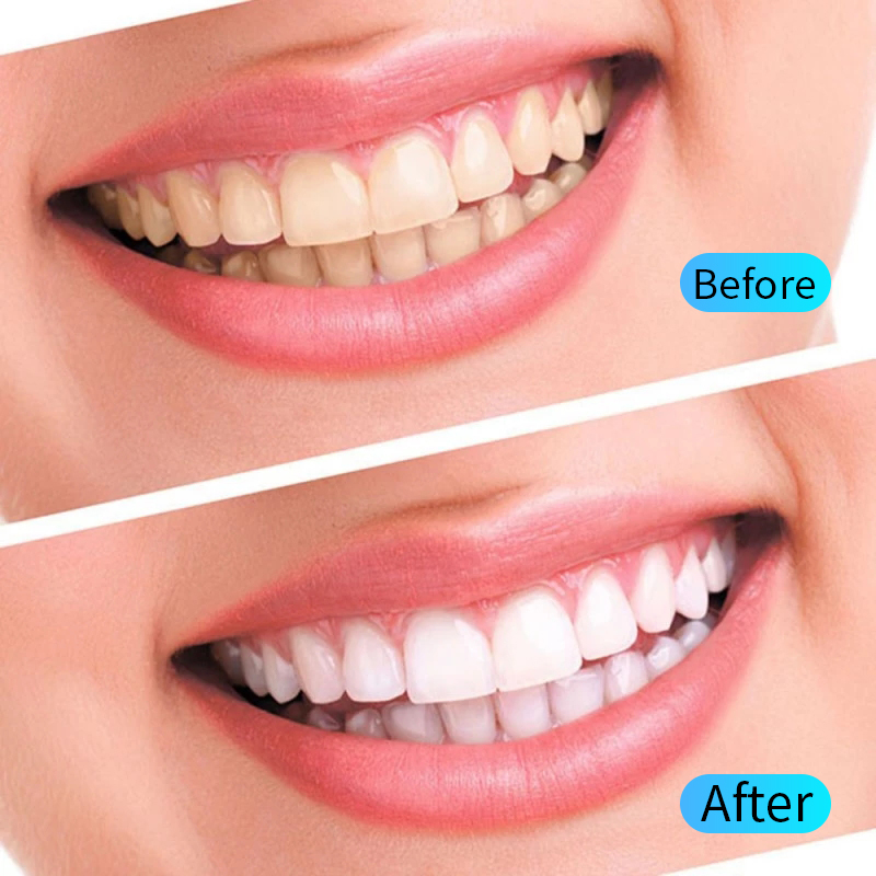 Diş Beyazlatma Jeli Seti Ağız  - Teeth Whitening Filter incelemesi ve fiyatı
