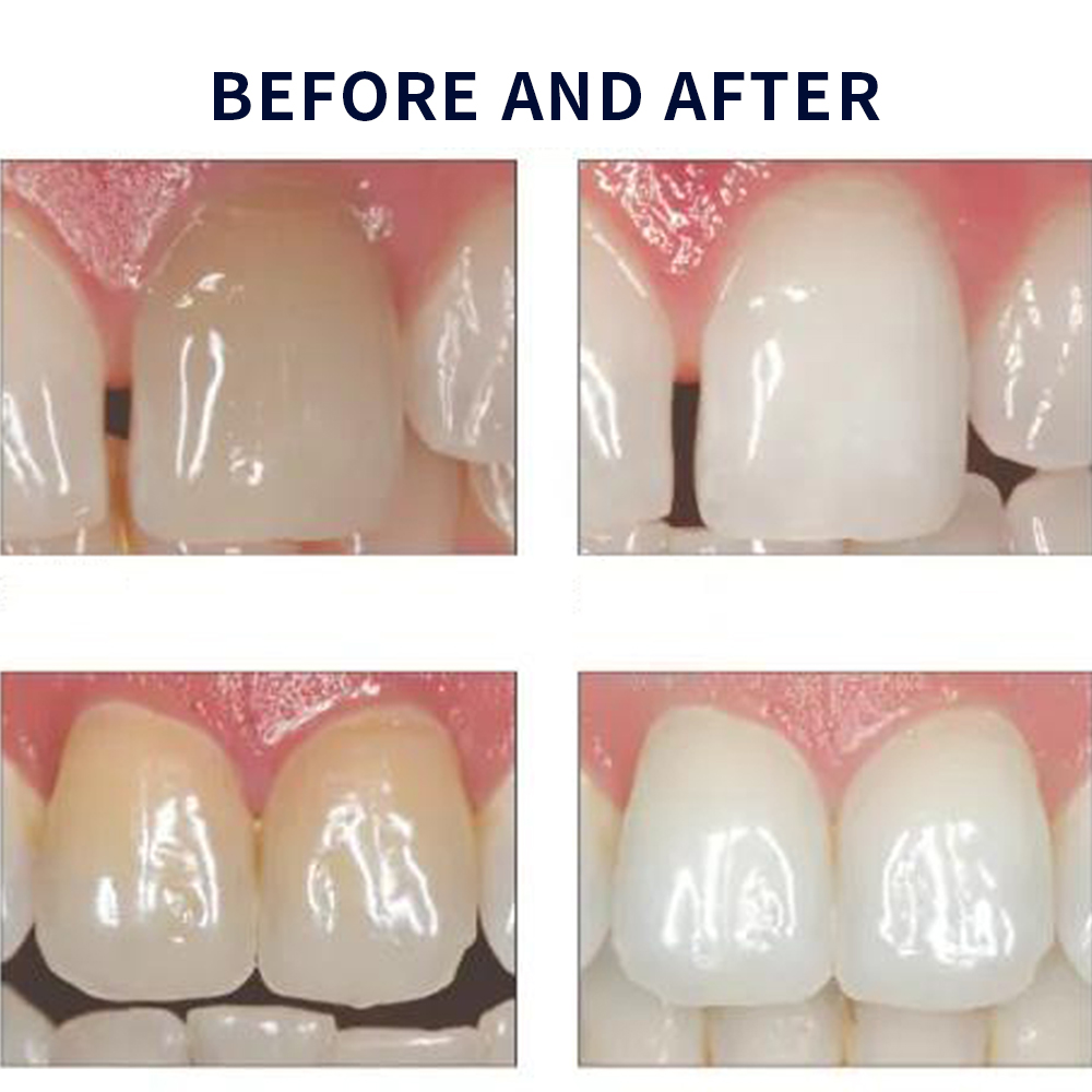 Opalescence beyazlatma 20% PF  - Teeth Whitening Hydrogen Peroxide incelemesi ve fiyatı