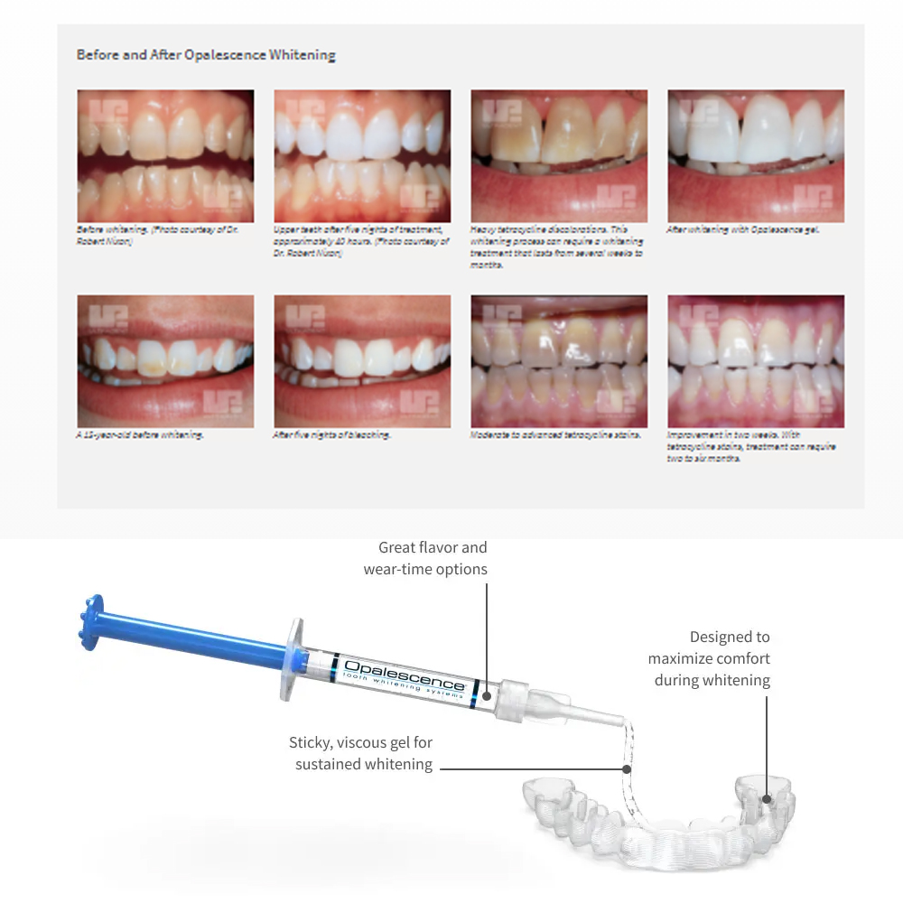 Opalescence beyazlatma 20% PF  - Teeth Whitening Hydrogen Peroxide incelemesi ve fiyatı