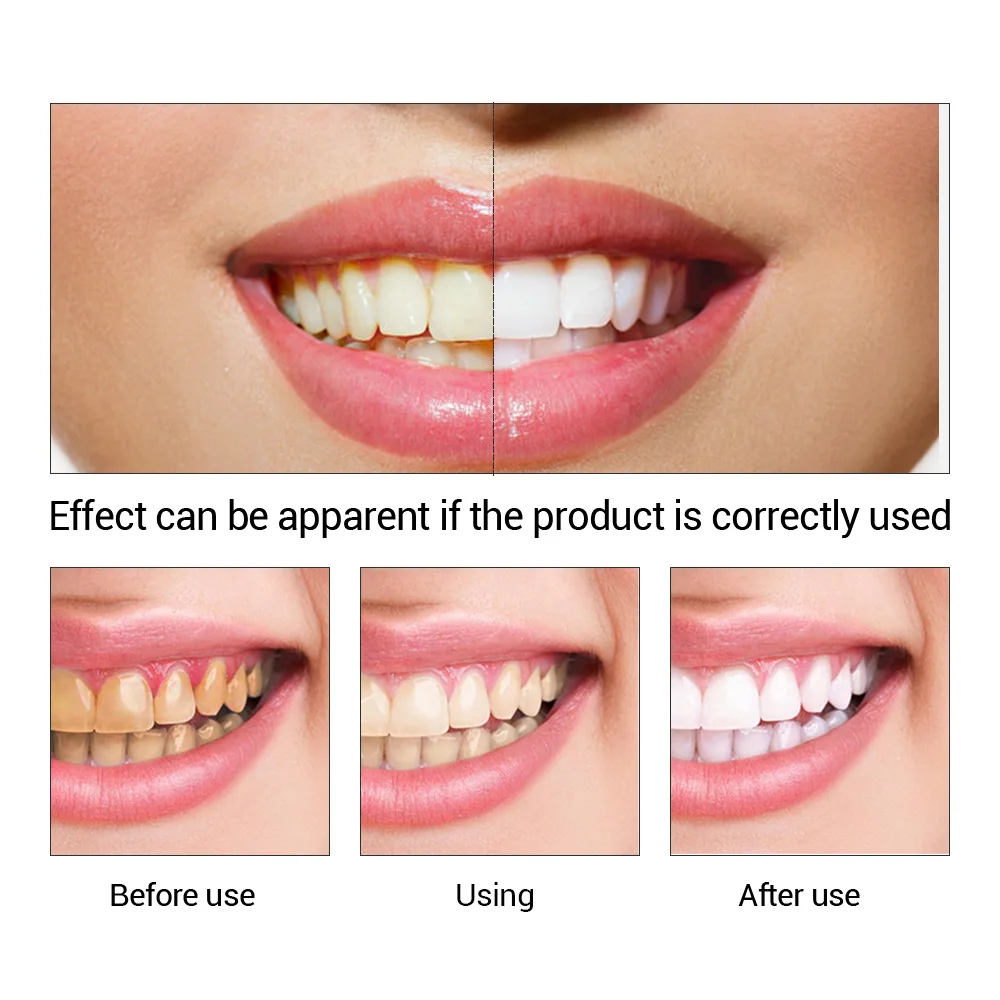 FTEENPLY diş beyazlatma özü to - Teeth Whitening (Bleaching) incelemesi ve fiyatı