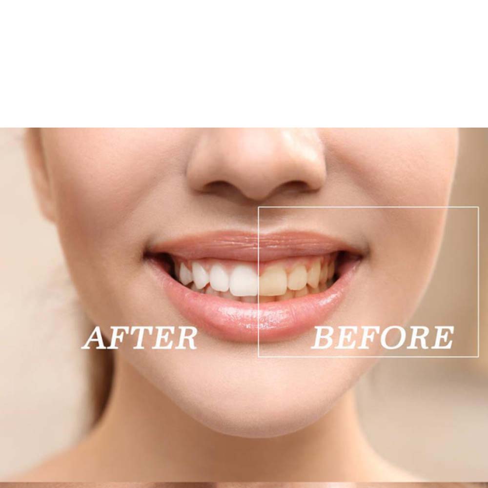 En kaliteli peroksit diş beyaz - Teeth Whitening Light Kit incelemesi ve fiyatı