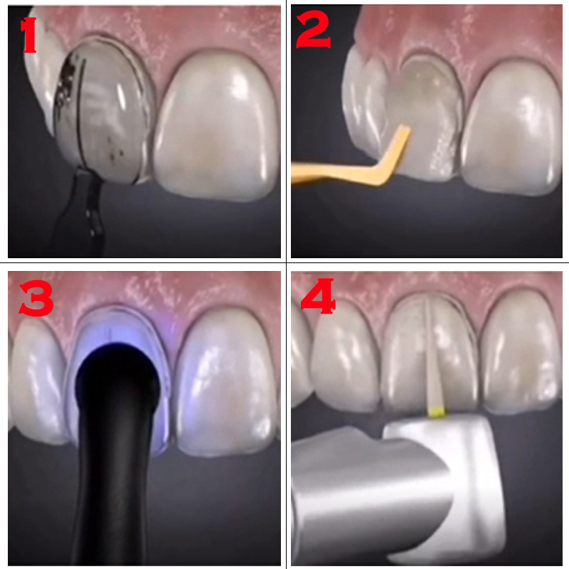 32 adet Diş Kaplama Kalıp Seti - Teeth Whitening Light Kit incelemesi ve fiyatı